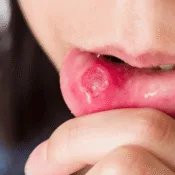 How to Treat Severe Mouth Ulcers