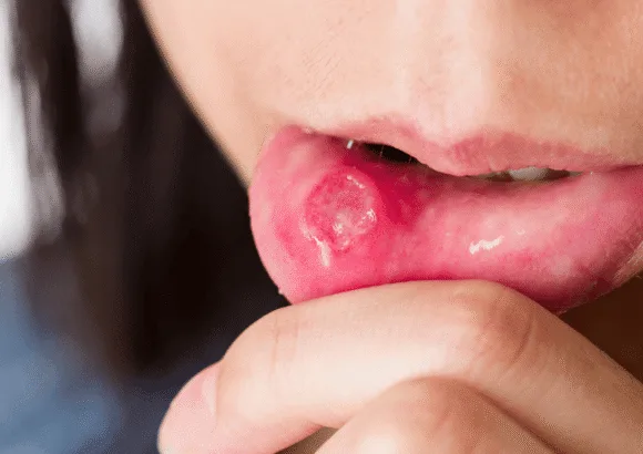 How to Treat Severe Mouth Ulcers? 😖🦷