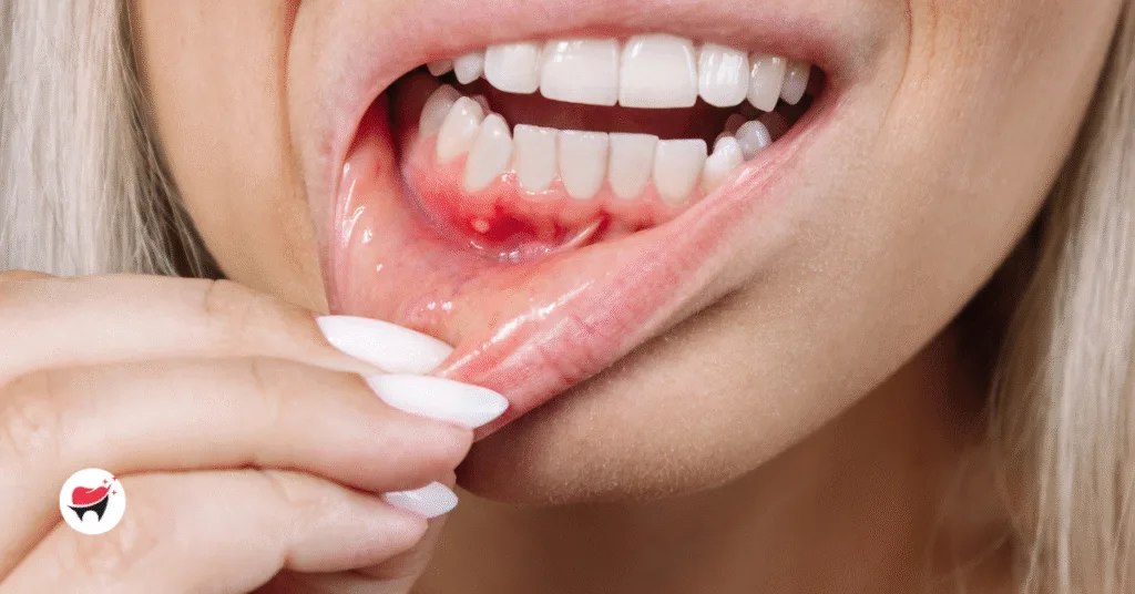 Why is My Gum Swollen Around One Tooth in the Back? 🦷🤔