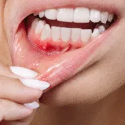 Why is My Gum Swollen Around One Tooth in the Back