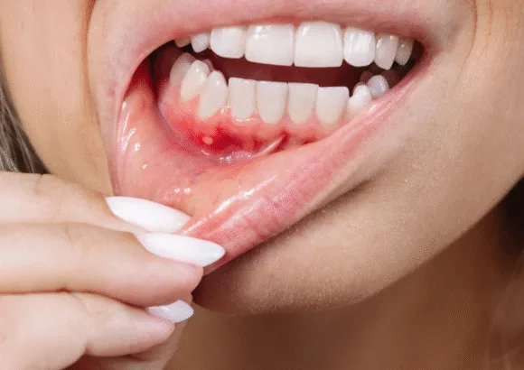 Why is My Gum Swollen Around One Tooth in the Back? 🦷🤔