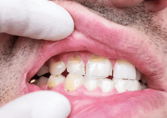 Can Tooth Enamel Erosion Be Reversed? A Dentist’s Guide to Remineralization and Restoration