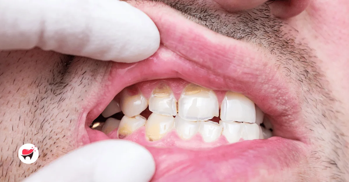 Can Tooth Enamel Erosion Be Reversed A Dentist's Guide to Remineralization and Restoration