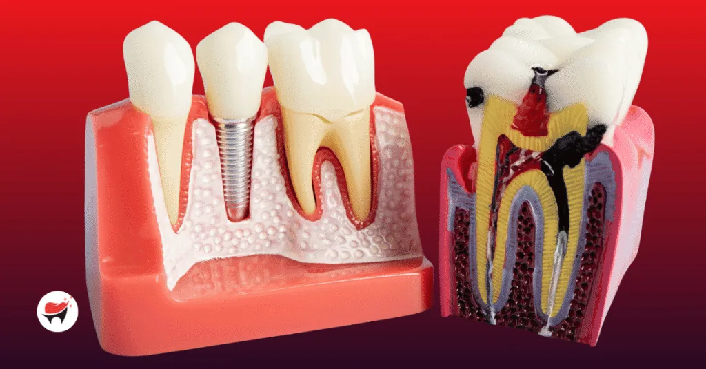 Root Canal vs. Implant: Which is More Painful? A Dentist’s Honest Comparison