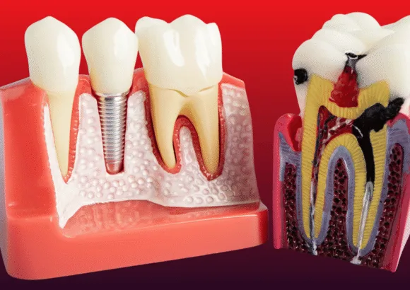 Root Canal vs. Implant: Which is More Painful? A Dentist’s Honest Comparison