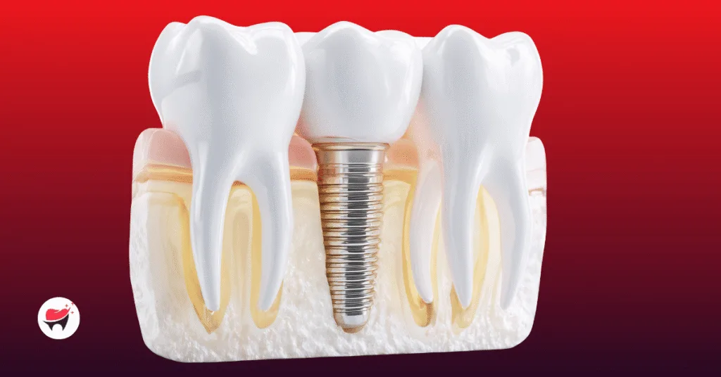 More Than Just a Smile: Unlocking the Life-Changing Benefits of Dental Implants