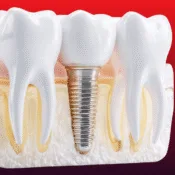 More Than Just a Smile: Unlocking the Life-Changing Benefits of Dental Implants