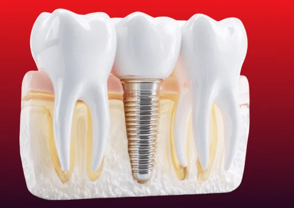 More Than Just a Smile: Unlocking the Life-Changing Benefits of Dental Implants